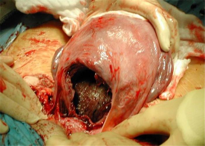 剖腹产取出婴儿的子宫图片