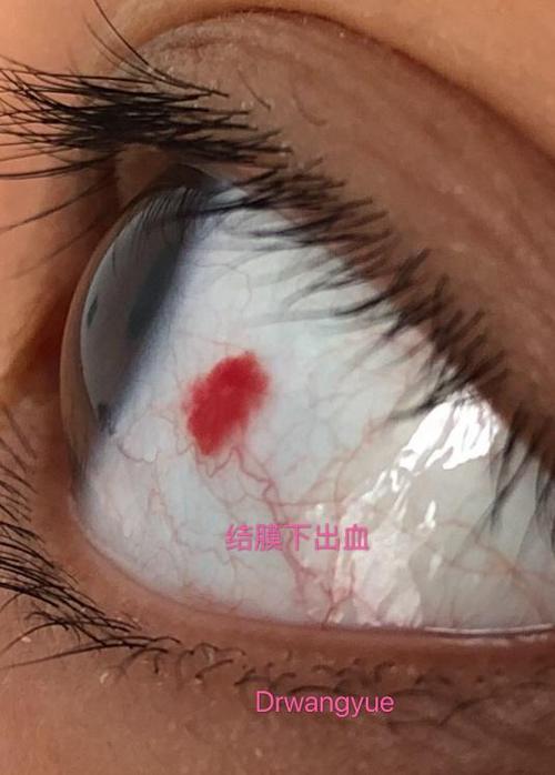 白眼球突然出血,要不要去眼科就诊?