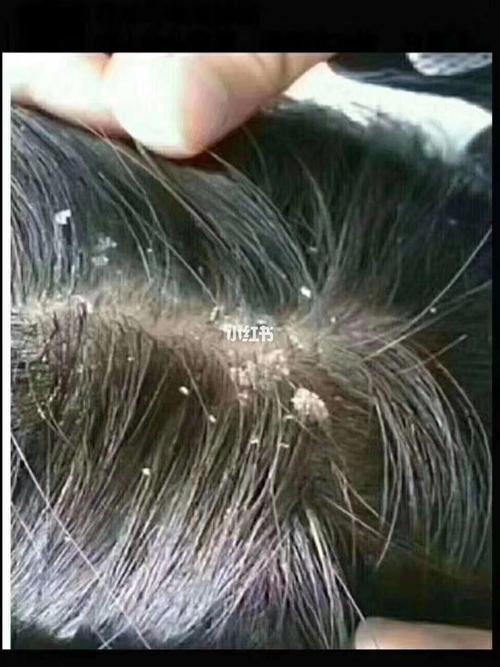 头部毛囊炎 头屑 头癣 头部牛皮癣脂溢性_头屑_毛囊炎