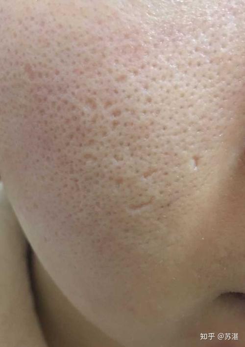 18岁痘坑毛孔,好自卑啊,害,有没有什么办法改善,和提升心里素质?