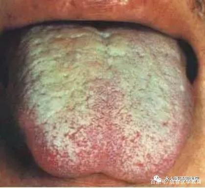 (二十四),黑燥苔胃癌患者临终前二天,舌苔黑而燥裂,根部黑苔长如黑毛