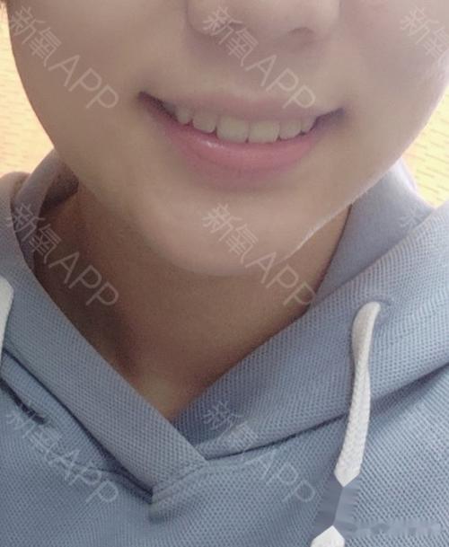 2019-8-1两边智齿都拔完了 现在脸型变成了这_圈子