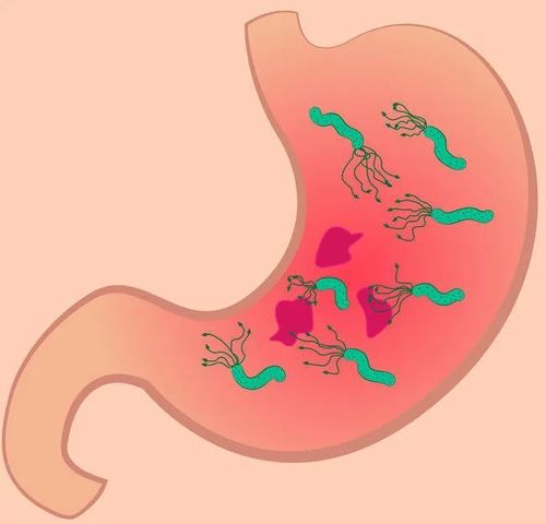 一半中国人感染幽门螺杆菌,不根治易遭胃癌?华西专家