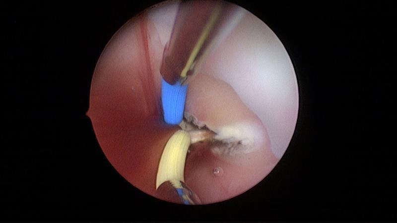 积血,积液以及斜隔侧的肾脏,输尿管缺如,另一侧肾脏,输尿管多发育正常