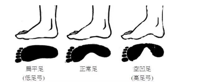 看准脚型 选对跑鞋,才是跑步训练的基础!