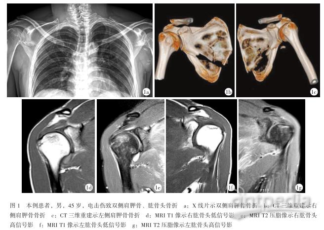 电击伤致双侧肩胛骨及肱骨头骨折病例分析