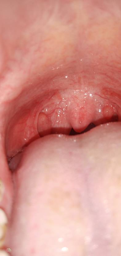 我慢性咽炎十来年了,最近嗓子上长个肉疙瘩越来越大,很痛声音嘶哑,说