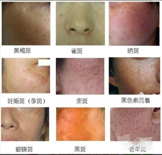 色斑的种类(色斑的科普小知识)