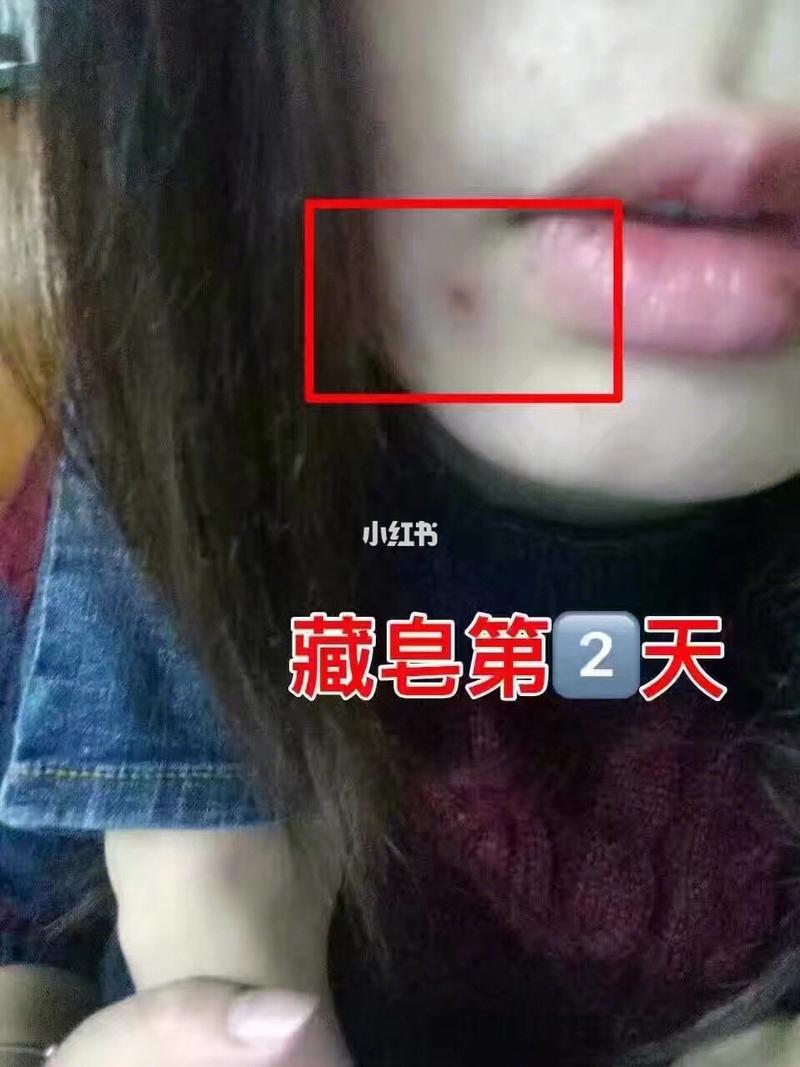 超级大的火痘痘 藏皂洗了三次就几乎消下去了 长痘痘的小姐姐一定记住