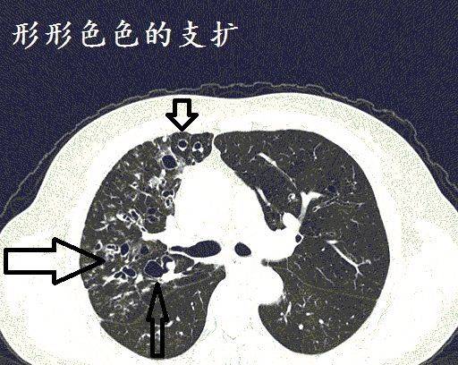 经典图谱,详细解说支气管扩张ct小诀窍!学不会我拜你为师!
