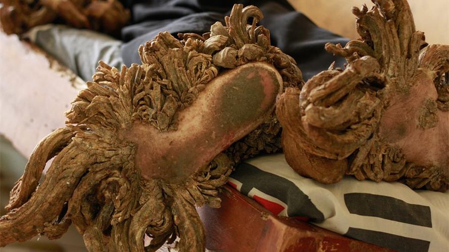 印尼"树人",手脚长出树根,饱受折磨数十年_迪德