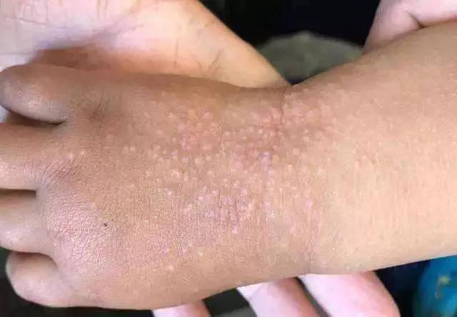 正常情况下,这种"沙土皮炎"1个月左右就可逐渐自愈.