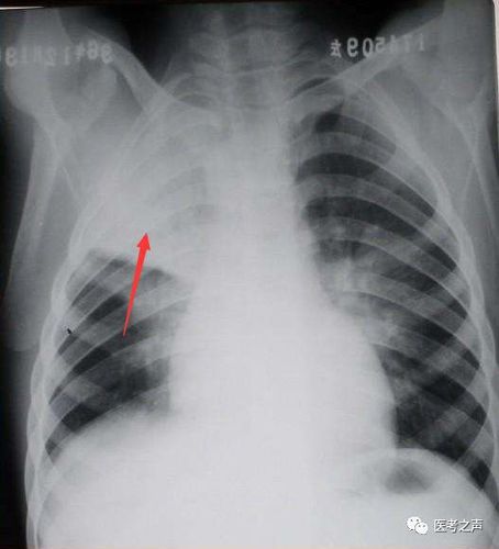 ②  小叶性肺炎