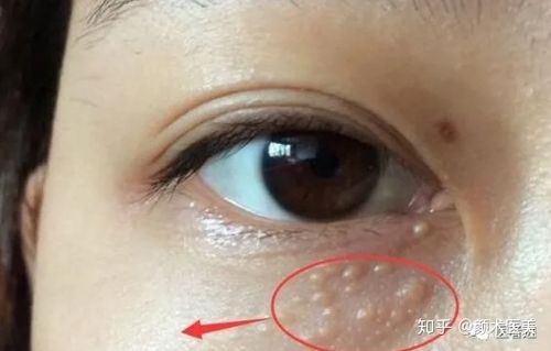 皮脂腺异位症不引起任何不适,故不需要治疗,特别在眼部更是如此.