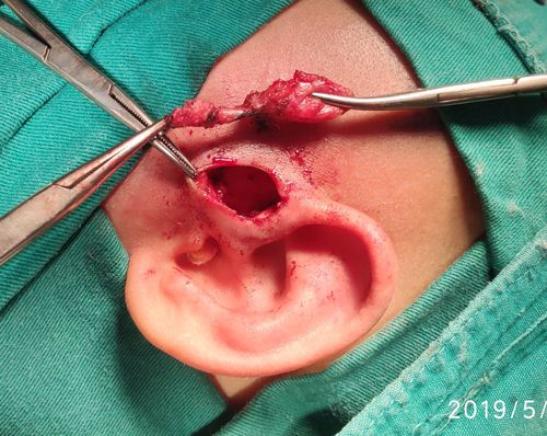 秦昊秦昊医生手记～20190515耳前瘘管切除