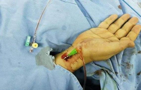 桡动脉穿刺置管