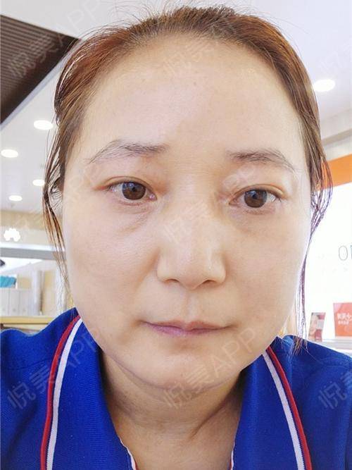 外切去眼袋术后42天_内切去眼袋术后42天_去眼袋术后42天_眼部整形术