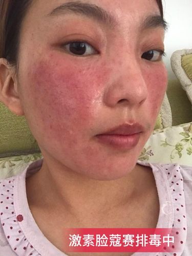 激素脸反馈