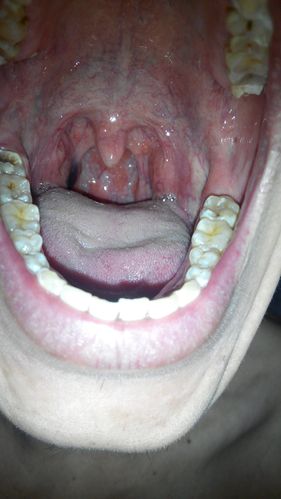 问:扁桃体处有暗红色的异物