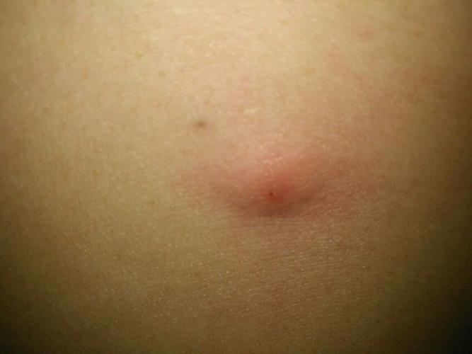 肚子上面一点长了一颗像痘痘一样的东西,像一个硬块,摸起来像一个硬块