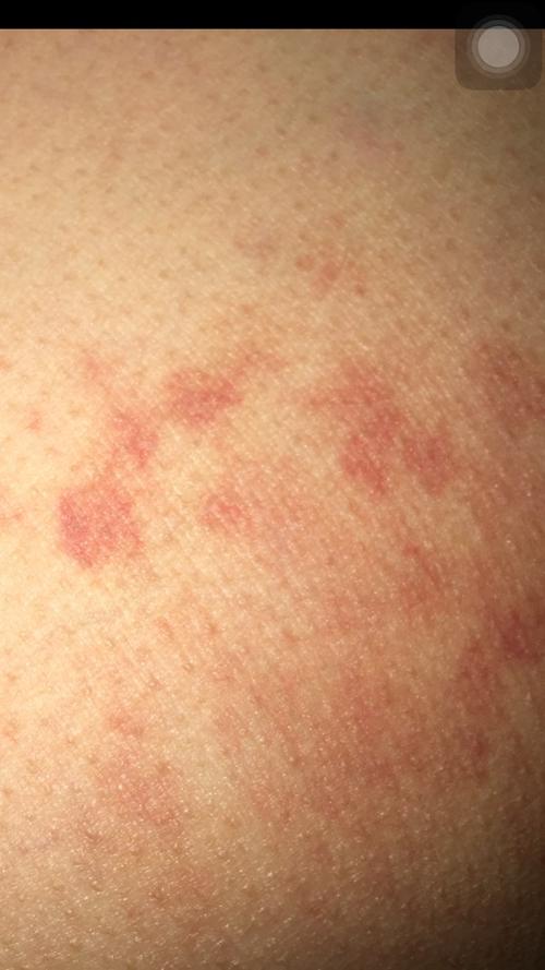 屁股两侧下大腿根有红色的像血印一样是什么东西