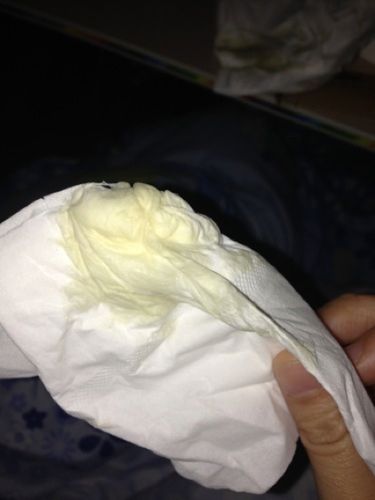 阴道总流出黄绿色呈黏稠液体,不知道是什么病,阴唇也有点肿痛