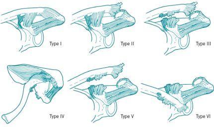 萨拉赫肩伤 ——是典型的肩锁关节脱位吗?