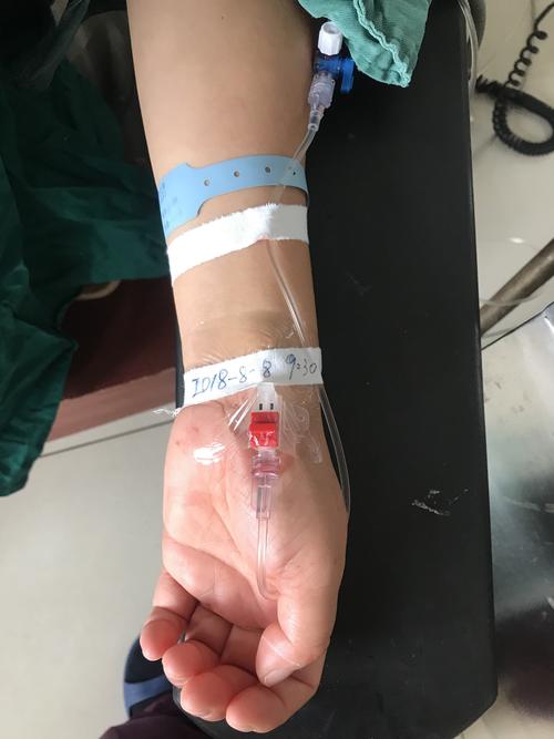 经皮桡动脉穿刺置管连续动脉测压术