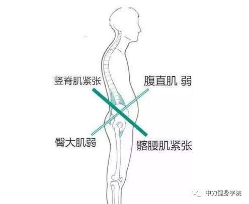 常见案例:下交叉综合征