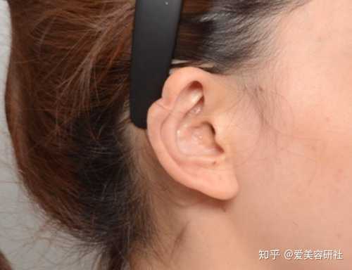 有遇到过取耳软骨后,耳朵凹陷的情况吗?
