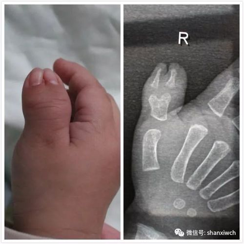 【烧伤整形科】关于"六指"宝宝的那些事儿