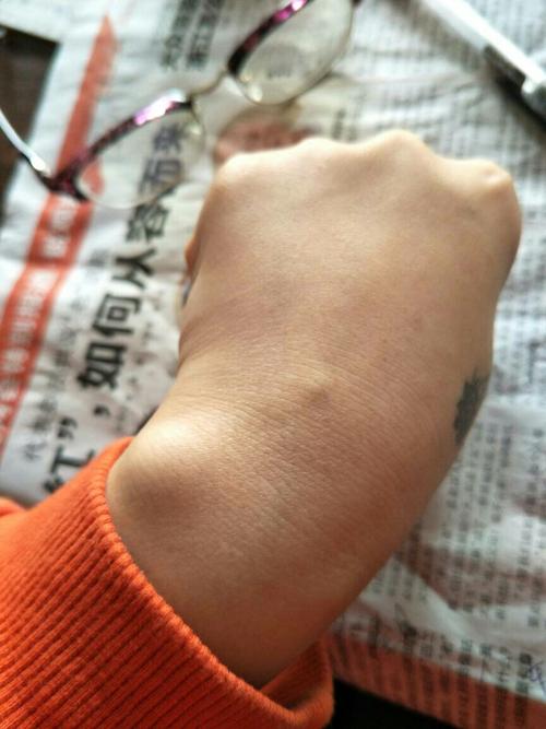 手背血管凸起小包,是什么原因什么情况?