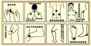 膏药贴敷示意图