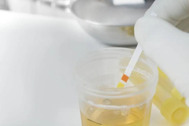 出现蛋白尿就是得了肾病明确告诉你不一定但要警惕3点