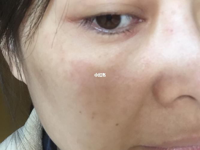 怡丽丝尔眼霜过敏了01_眼霜_敏感肌_眼纹_怡丽丝尔怎么样_毁容_美妆