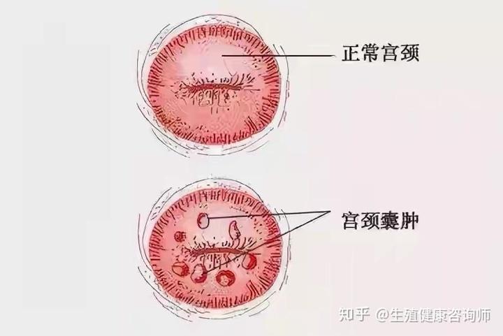 宫颈纳囊需要治疗吗会引起不孕吗