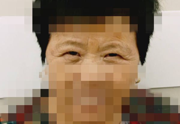 针灸治疗眼睑痉挛,上睑下垂 效果明显