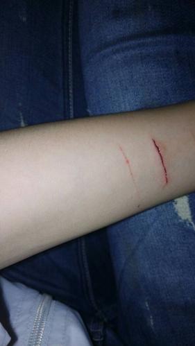 手臂不小心被刀割了 不是很深 还是有点深会不会留疤