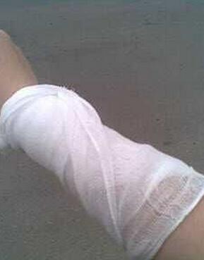 宝宝烫伤能包扎吗要怎么包扎