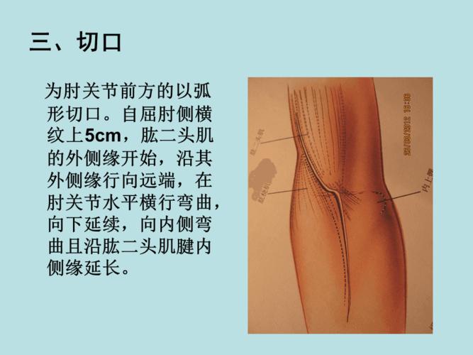 桡骨头及桡骨近端的手术入路与解剖