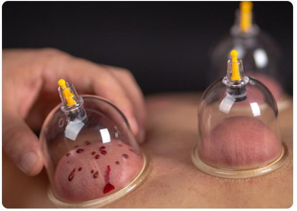 拔火罐时,后背吸出的瘀血,真的是毒素吗?大夫说出大实话