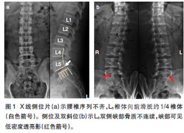 腰椎滑脱症的影像学特征