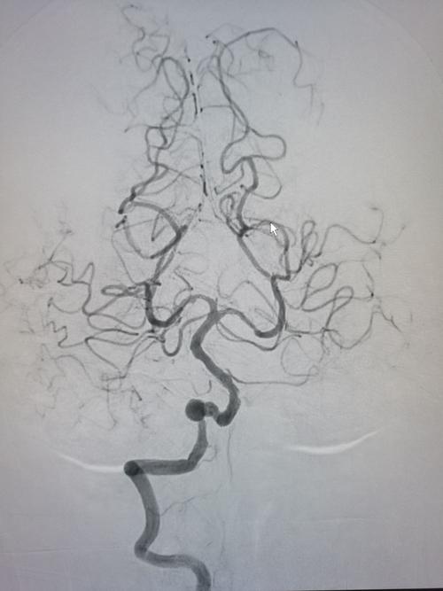 右椎动脉造影显示v4段动脉瘤,pica似乎未见.