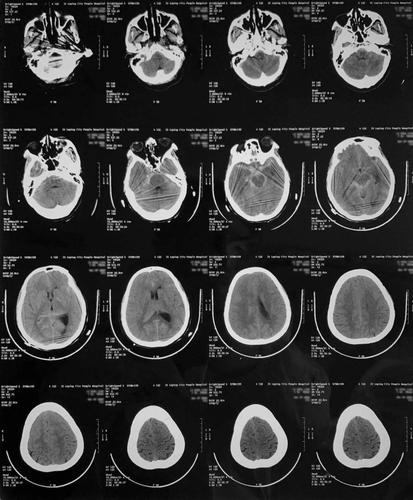 我院复查头颅ct:蛛网膜下腔出血.