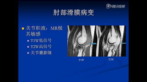 肘关节mri诊断