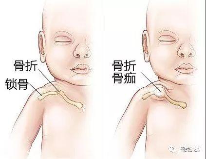 小知识:锁骨骨折的症状是什么?