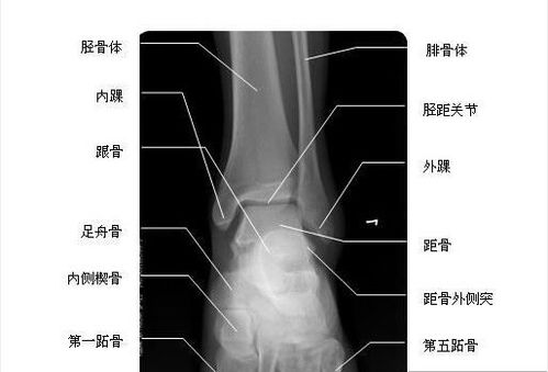 踝关节正位-x线-解剖图片