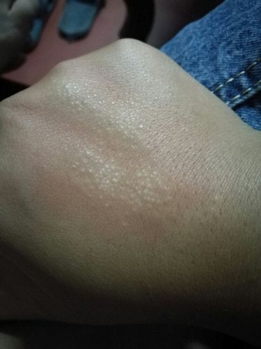 手面上以及手臂上长了很多白色小疙瘩跟鸡皮似的,很痒