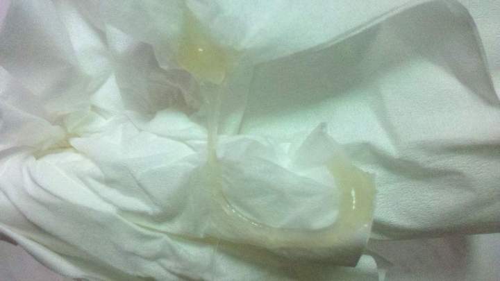 洗澡留心观察若hpv感染超过2年留意内裤有这东西预示着宫颈癌