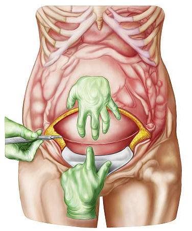 会发生子宫切口裂伤,产后大出血,羊水栓塞等危害产后女性健康的并发症